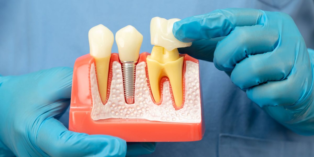 cuanto duran los implantes dentales